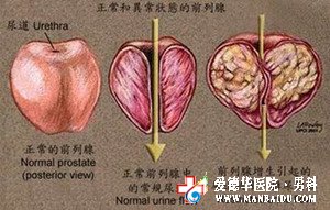 前列腺偏大怎么治療_九江醫(yī)大醫(yī)院