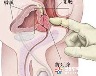 把前列腺炎止于萌芽階段