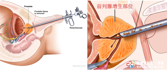 前列腺增生怎么治療？