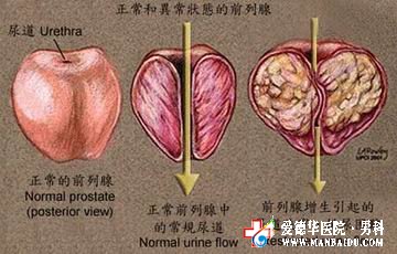 前列腺肥大如何治療效果好?