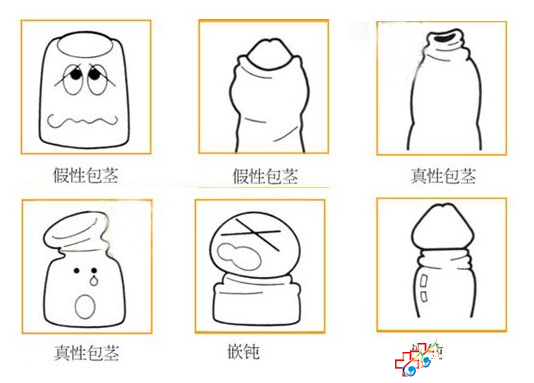 包皮手術的疑問，專家來解答 九江醫大醫院
