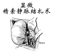 腹腔鏡下精索靜脈曲張微創(chuàng)術