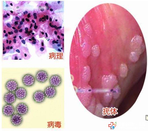 防復(fù)發(fā)是治愈尖銳濕疣的關(guān)鍵