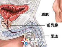 得了膀胱結(jié)石怎么辦