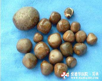 男性為何易患前列腺結石