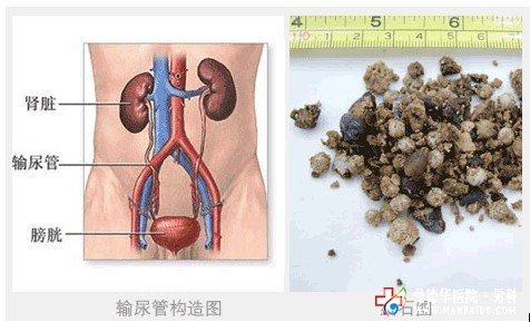 膀胱結(jié)石的危害如何