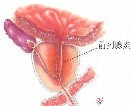 引起細(xì)菌性前列腺炎反復(fù)發(fā)作的原因