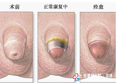 九江男科醫院微創包皮手術效果好嗎