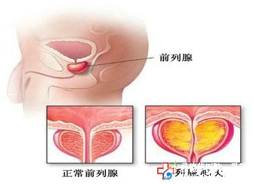 治療前列腺增生什么技術可以治愈？—九江男科醫(yī)院