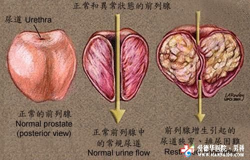 九江專治前列腺增生醫院—九江醫大醫院