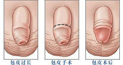 九江市包皮手術(shù)后注意什么