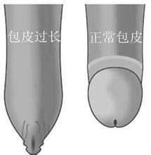 五歲男孩陰莖包皮內(nèi)側(cè)有包