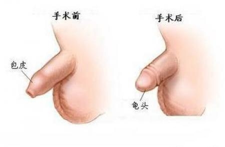 九江市在哪里看包皮過(guò)長(zhǎng)