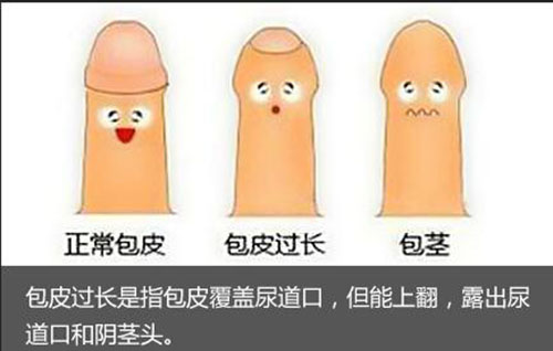 包皮過長判斷標準